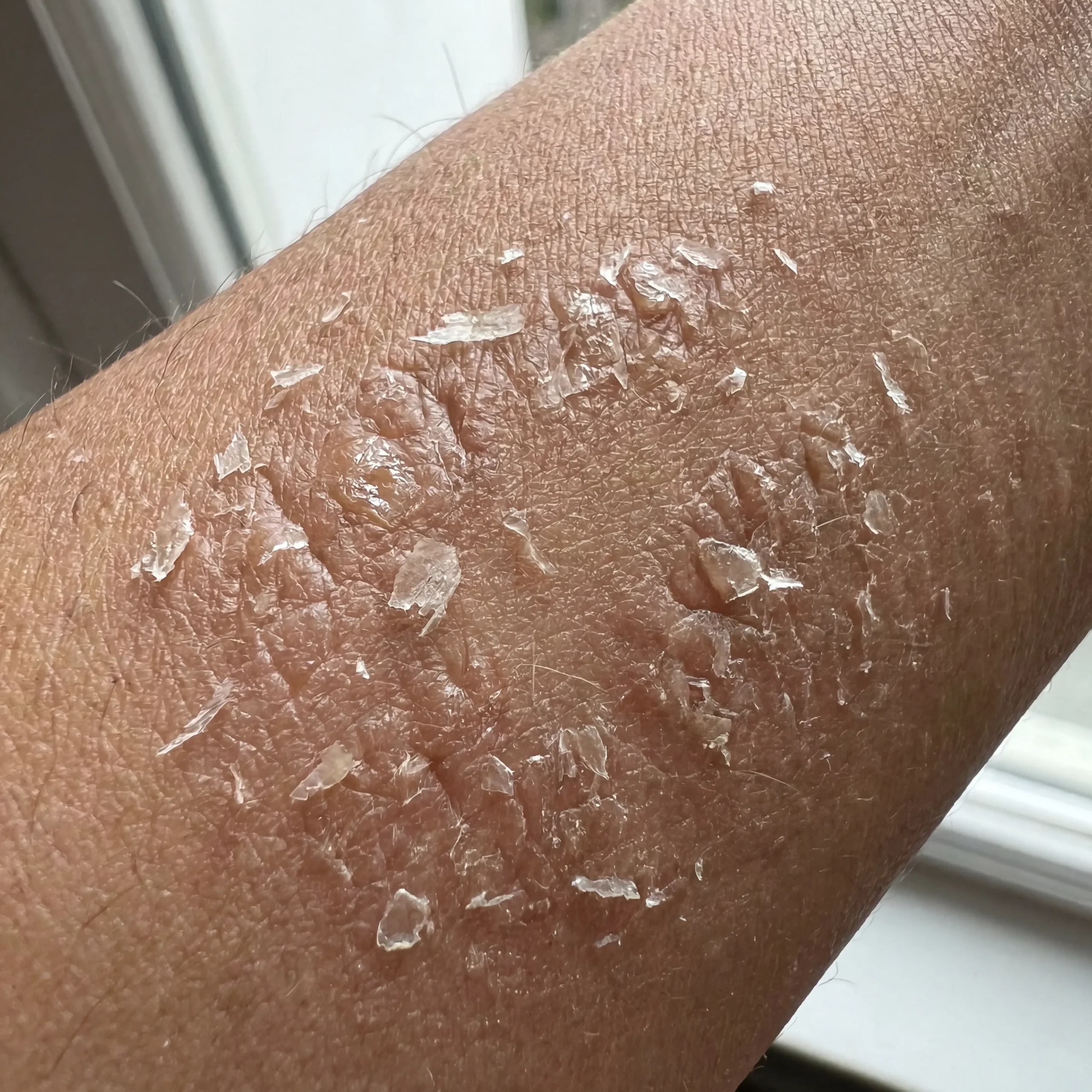 Dry skin icon